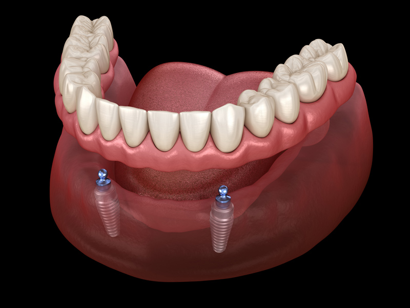 implant retained dentures 3d render