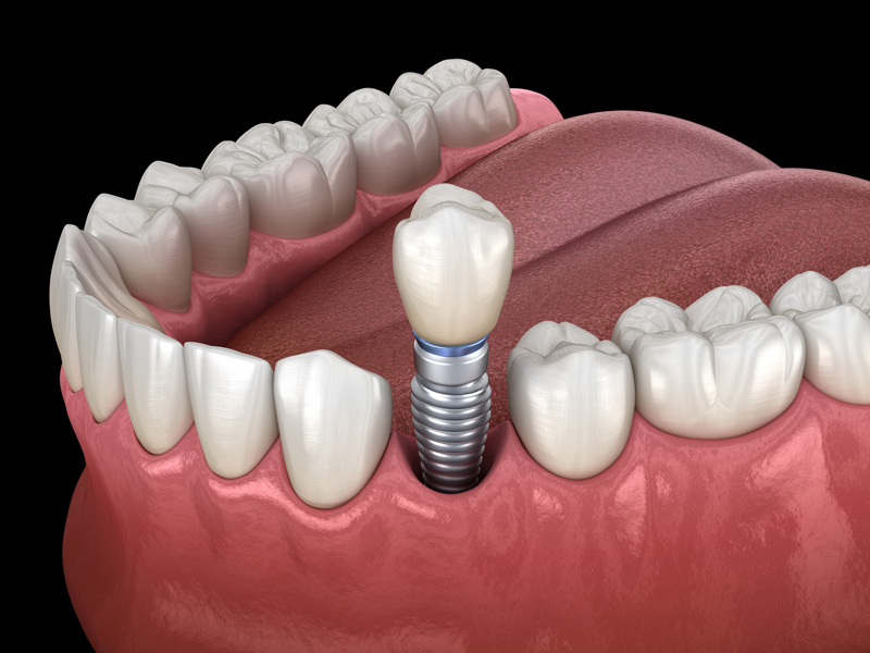 single tooth implant 3d render