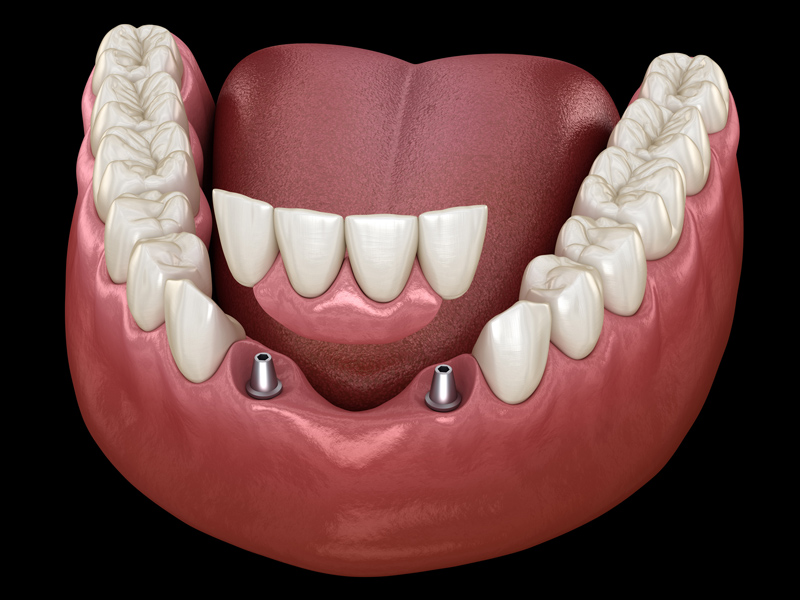 all in set of 4 implants 3d render