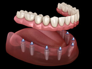 full arch of tooth implant 3d render