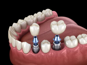 multiple tooth implant 3d render